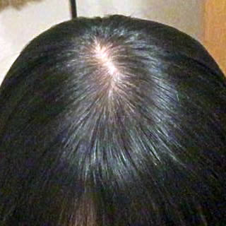 照明や太陽光に当たると頭皮が透けるのはもう薄毛 普通と正常の違い つむじ研究女 公式ブログ