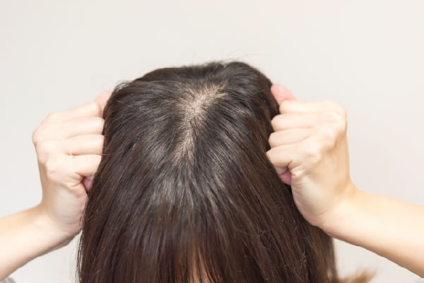 女性の頭頂部の薄毛やてっぺんハゲの原因と対策法 Bella